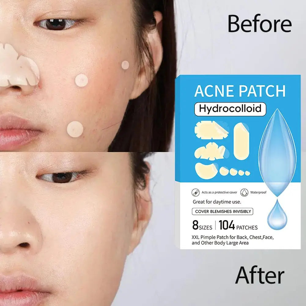 Hydrocolloid Acne Patches – Invisible Spot Treatment