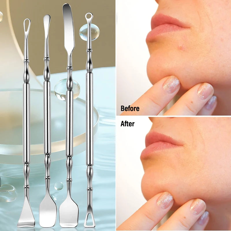 Stainless Steel Double-Head Blackhead Extractor Tool