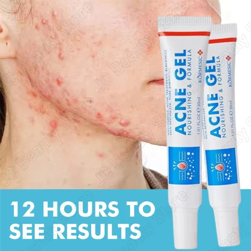 SADOER Salicylic Acid Acne Cream – Oil Control & Pore Minimizer
