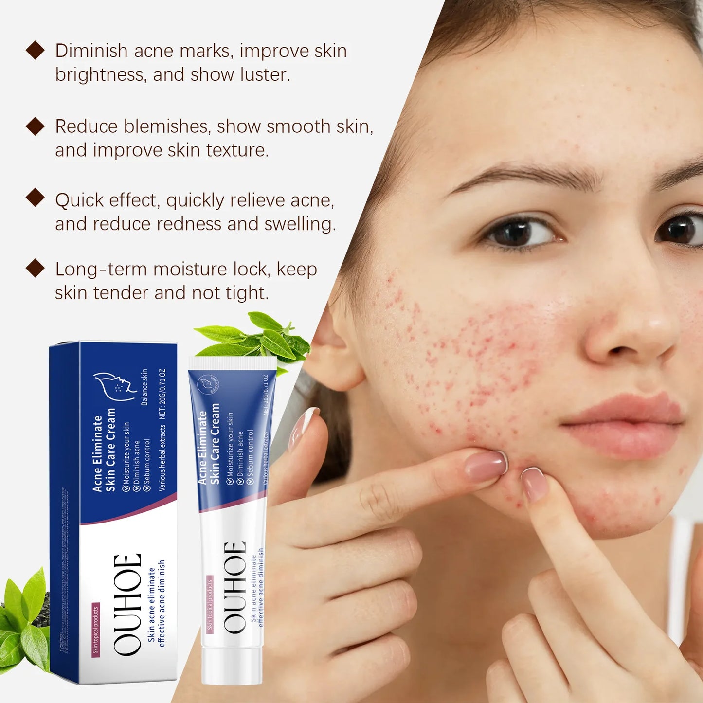 Herbal Acne Face Cream – Oil Control & Blemish Care 20g