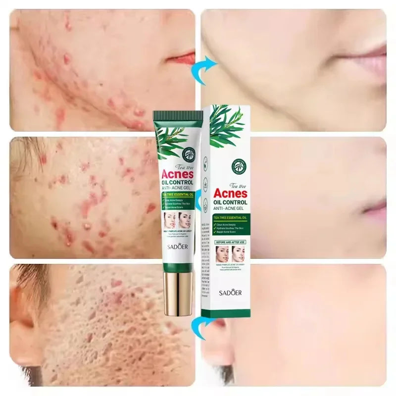 Tea Tree Acne Removing Cream Facial Mild Moisturizing Oil Control Acne Removing Facial Gel Eliminate Acne Pimples Beauty Health Peaceful Pleasures Health and Wellness