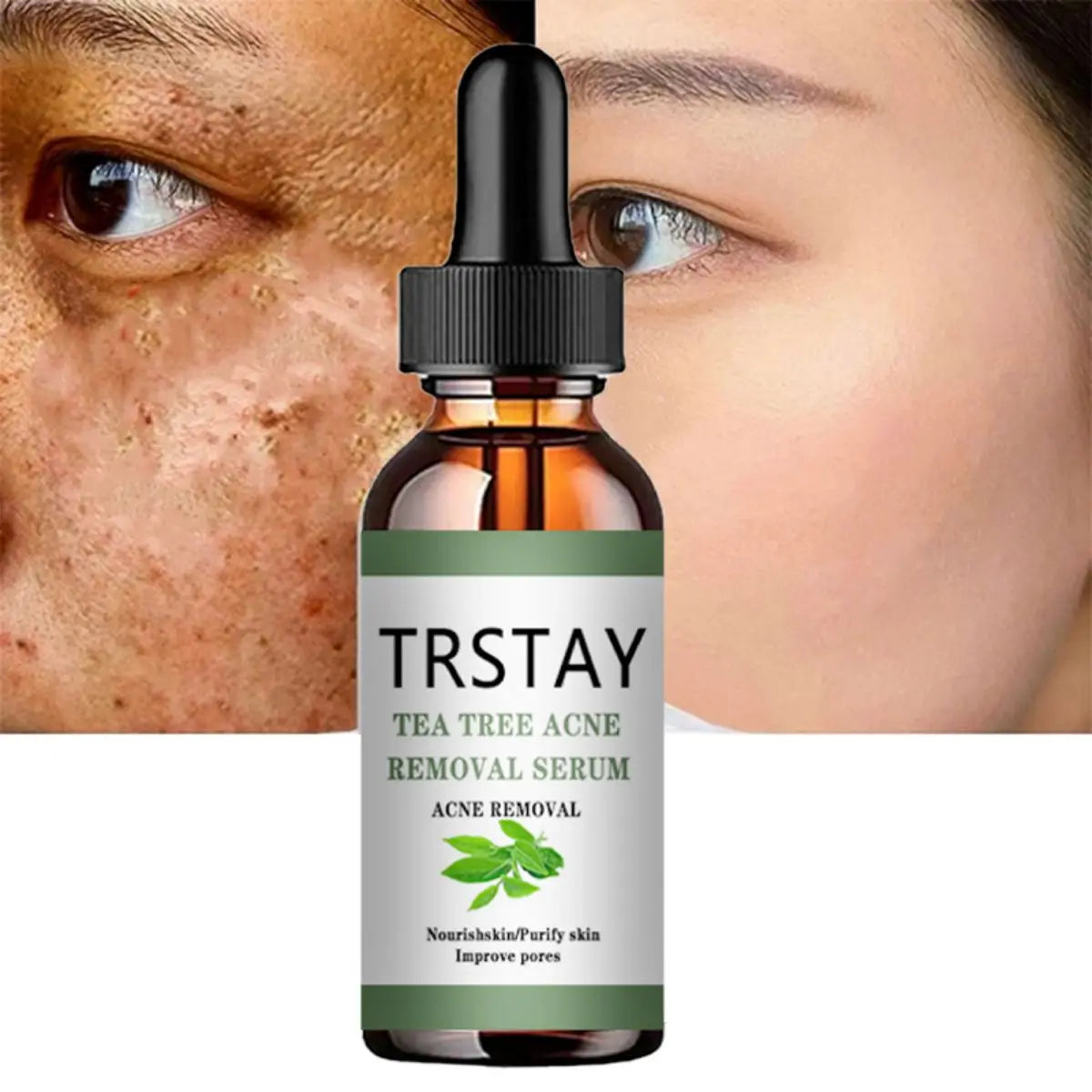 Acne Treatment Face Serum Tea Tree Oil Essence Moisturizing Shrink Pores Acne Facial Serum Korean Skin Care Products Peaceful Pleasures Health and Wellness