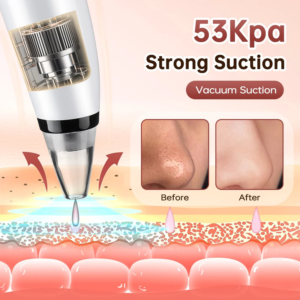 Blackhead Remover Facial Pore Cleaner 3 Suction Power Electric Pimple Acne Extractor Tool Face & Nose Whiteheads Vacuum Removal Peaceful Pleasures Health and Wellness