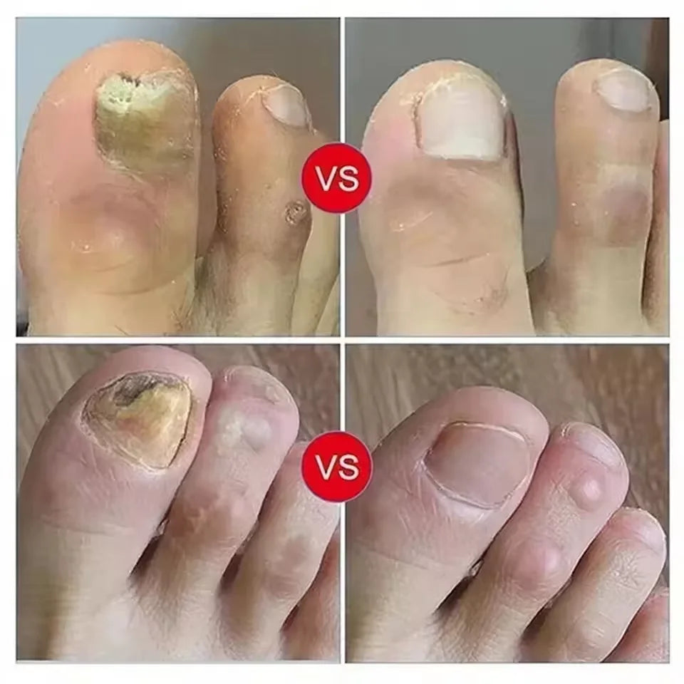 Fungal Nail Treatment Serum Foot Nail Fungus Removal Repair Gel Anti Infection Paronychia Onychomycosis Foot Nails Care Essence Peaceful Pleasures Health and Wellness