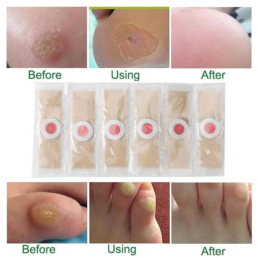 6-Pack Corn & Callus Remover Pads – Self-Stick Foot Patches