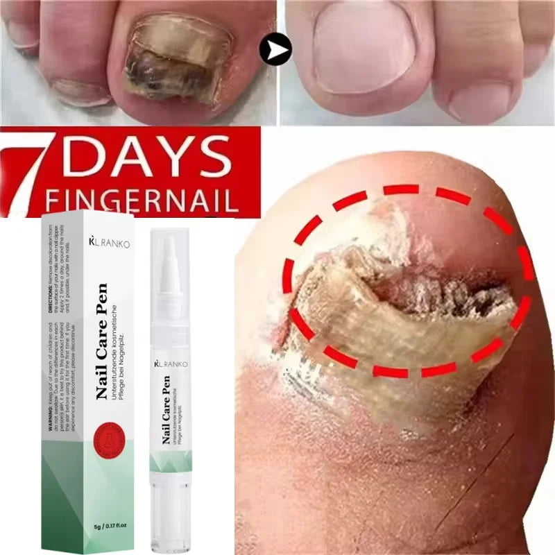 Nail Repair Serum – Foot & Toe Nail Restoration Oil