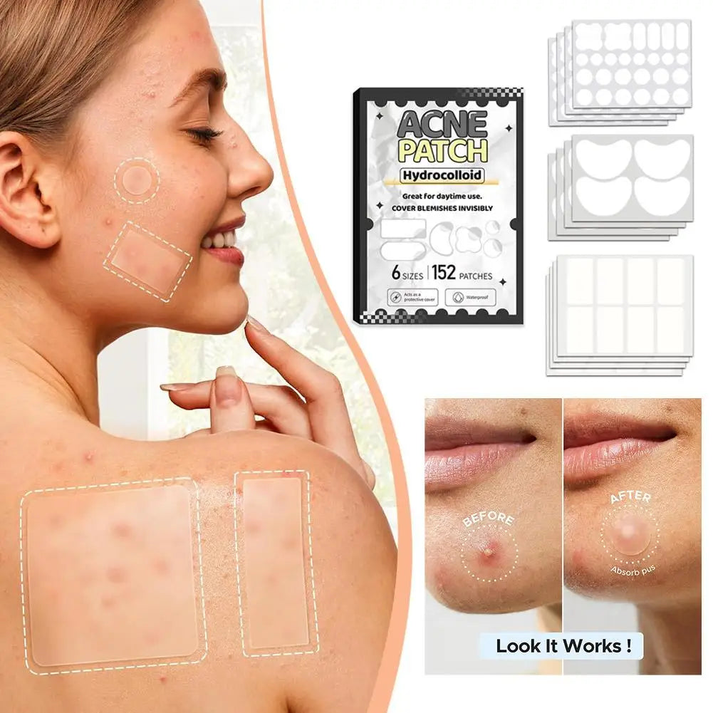 Hydrocolloid Acne Patches – Multi-Shape Invisible Blemish Dots