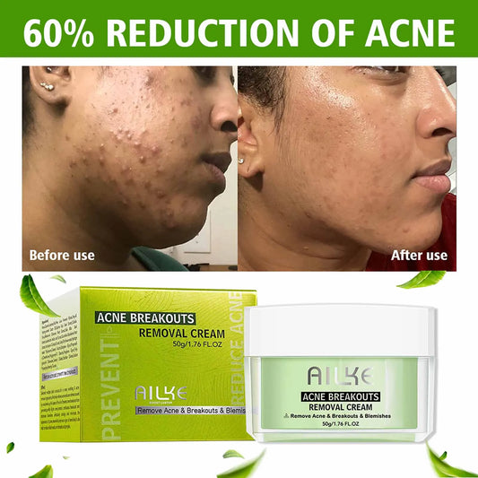 AILKE Acne Face Cream – Clear Skin, All Types | 50ml Acne Face Cream Peaceful Pleasures Health and Wellness Pack of 1 China Mainland