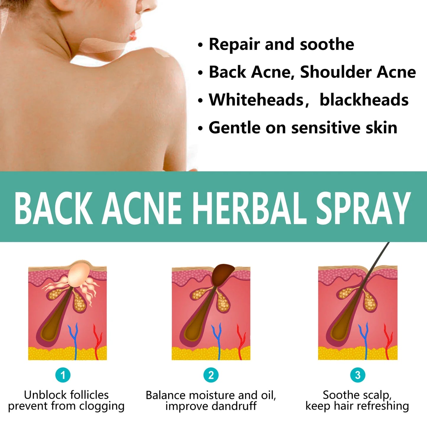 OceAura Herbal Acne Spray – Back, Shoulder & Pore Treatment