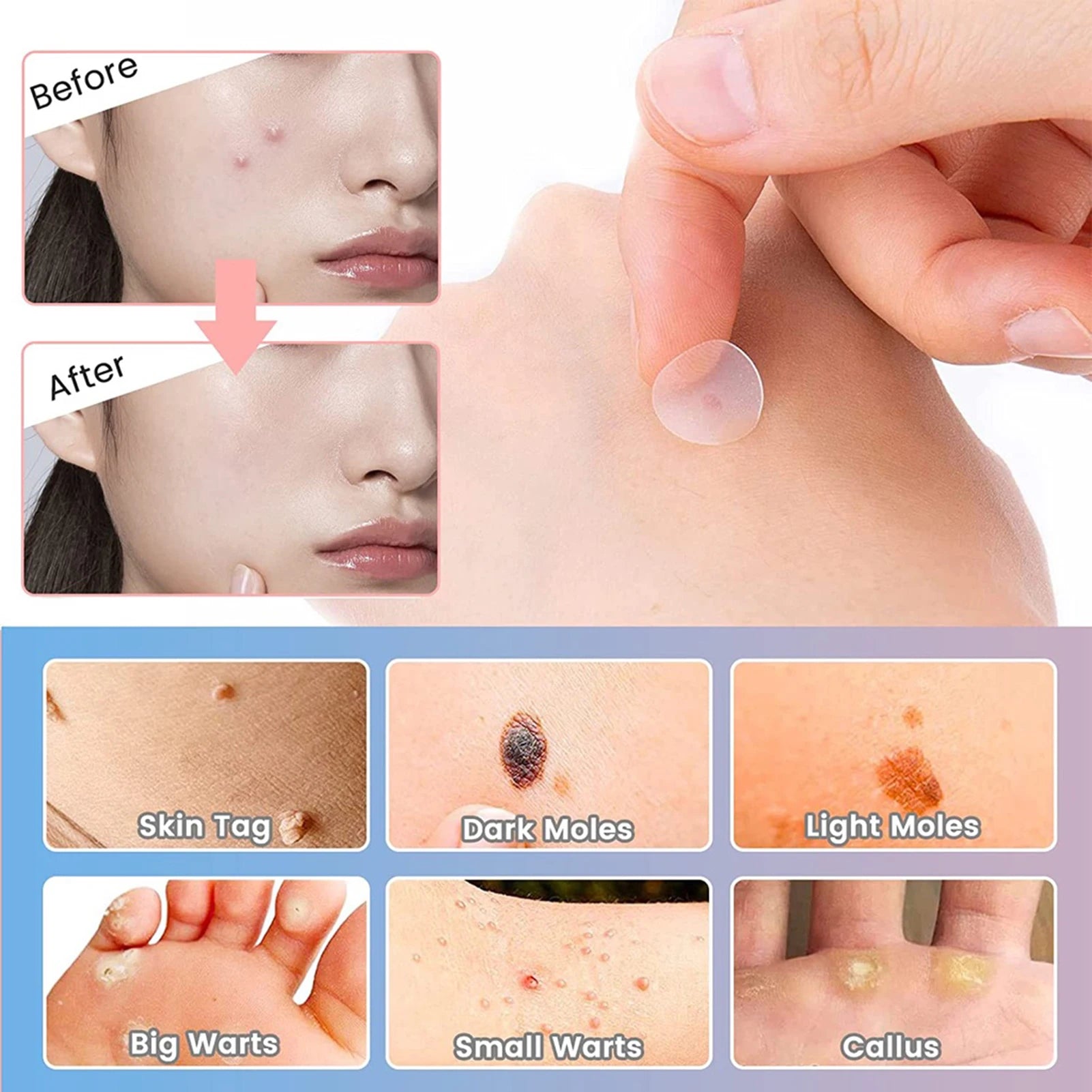 【Hot sales】72Pcs Invisible Removal Pimple Anti-Acne Hydrocolloid Patches Spots Marks Concealer Waterproof Repair Sticker Peaceful Pleasures Health and Wellness
