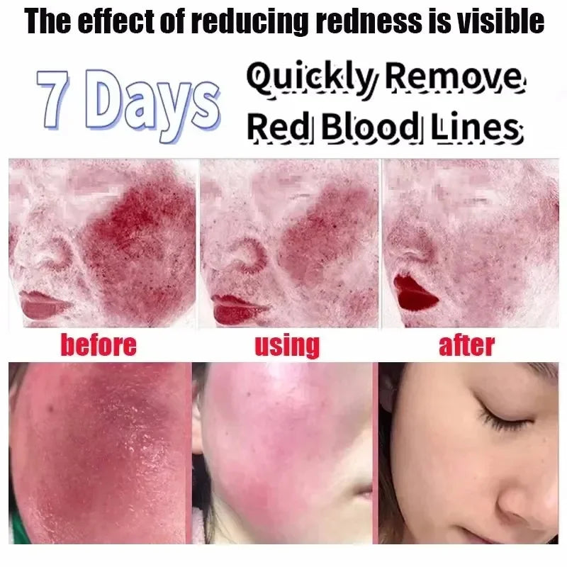 SADOER Redness Repair Serum for Rosacea & Sensitive Skin