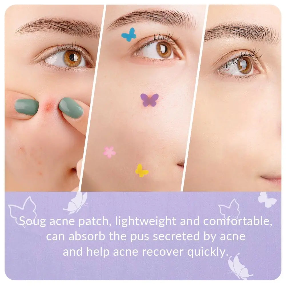 120 Counts Cute Colorful Butterfly Pimple Patches Acne Treatment Stickers Invisible Acne Cover Face Spot Pimple Patch Skin Care Peaceful Pleasures Health and Wellness