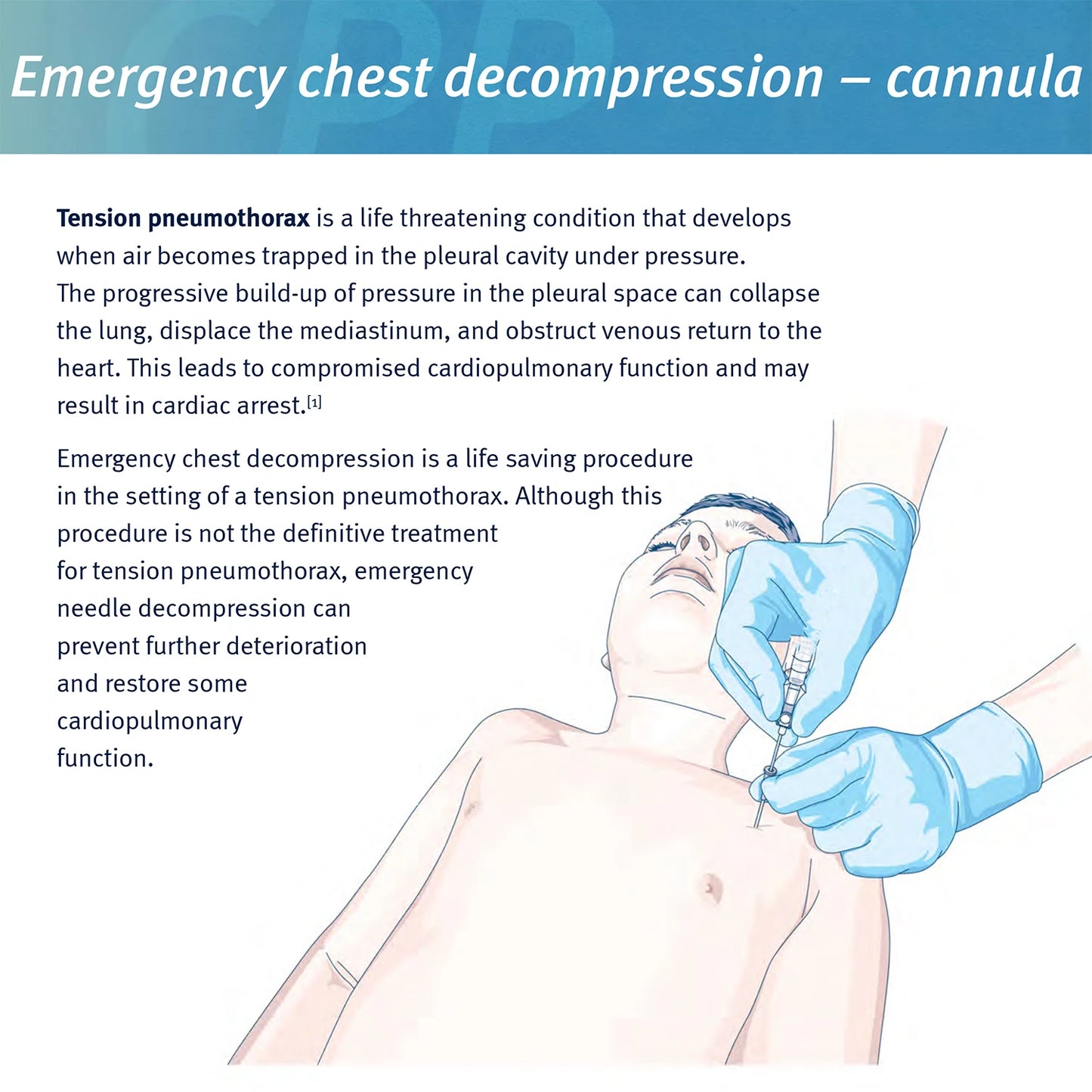 Sanke Rescue Pneumothorax Needle Trauma Medical Ifak Chest Cathether Needlecatheter 50g Needle Decompression Edc First Aid Kit Peaceful Pleasures Health and Wellness