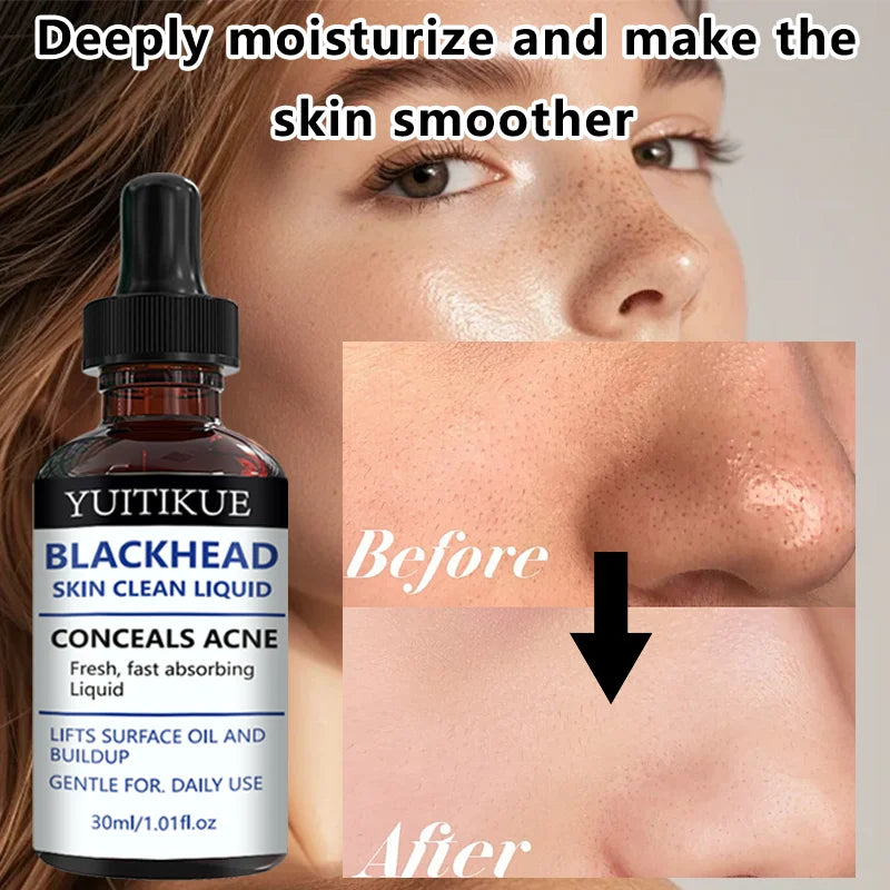 YUITIKUE Blackhead Remover Liquid Gentle Acne Oil Control Deep Cleansing Pore Refining Skin Care Peaceful Pleasures Health and Wellness