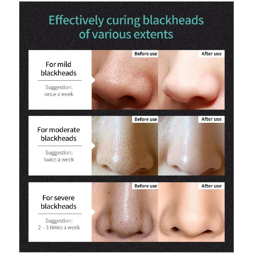 LANBENA Remove Blackhead Mask Shrinking Pore Deep Cleaning Mask Improve Rough SkinAnti-Acne Brighteing Skin Care Peaceful Pleasures Health and Wellness