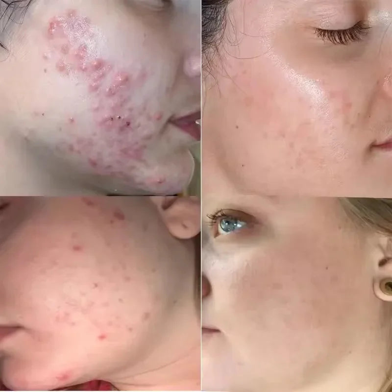 Tea Tree Acne Removing Cream Facial Mild Moisturizing Oil Control Acne Removing Facial Gel Eliminate Acne Pimples Beauty Health Peaceful Pleasures Health and Wellness