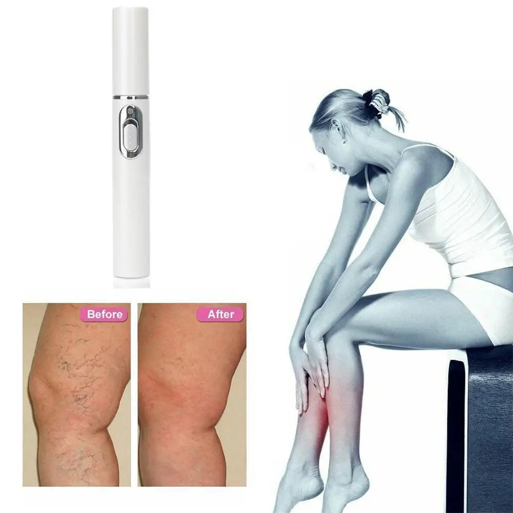 Skin Tag Removal Pen, Mole And Wart Removal Pen High-quality Anti Swelling Vessel Bulge Pain Blood Circulation Peaceful Pleasures Health and Wellness
