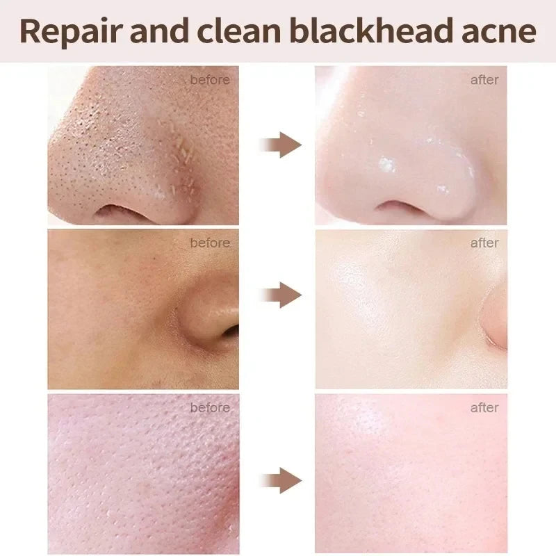 Salicylic Acid Pore Refining Cream – Oil Control & Blackhead