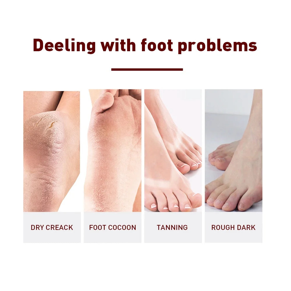 1 Pair Exfoliating Feet Mask Exfoliating Foot Peel Mask Socks Pedicure Peeling Dead Skin Remover Feet Mask Peel Moisturizing Peaceful Pleasures Health and Wellness
