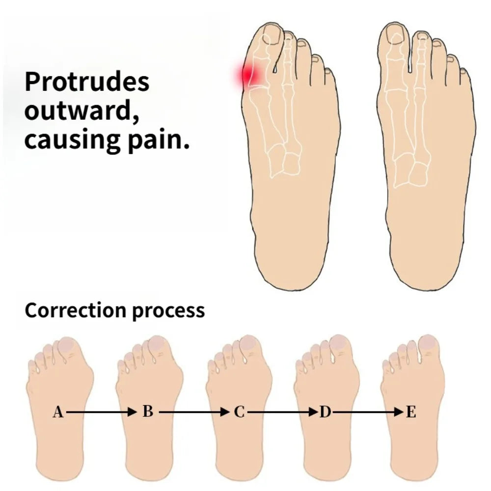 2pcs=1pair Protective Toes Separator Suitable Bunion Corrector Material Soft Gel Straightener Spacers Care Tool Small Easy Carry Peaceful Pleasures Health and Wellness
