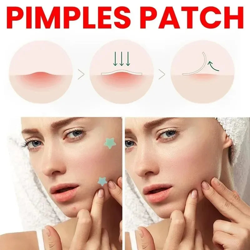 200pcs Acne Pimple Repair Patches | Fade Blemishes & Cover Spots