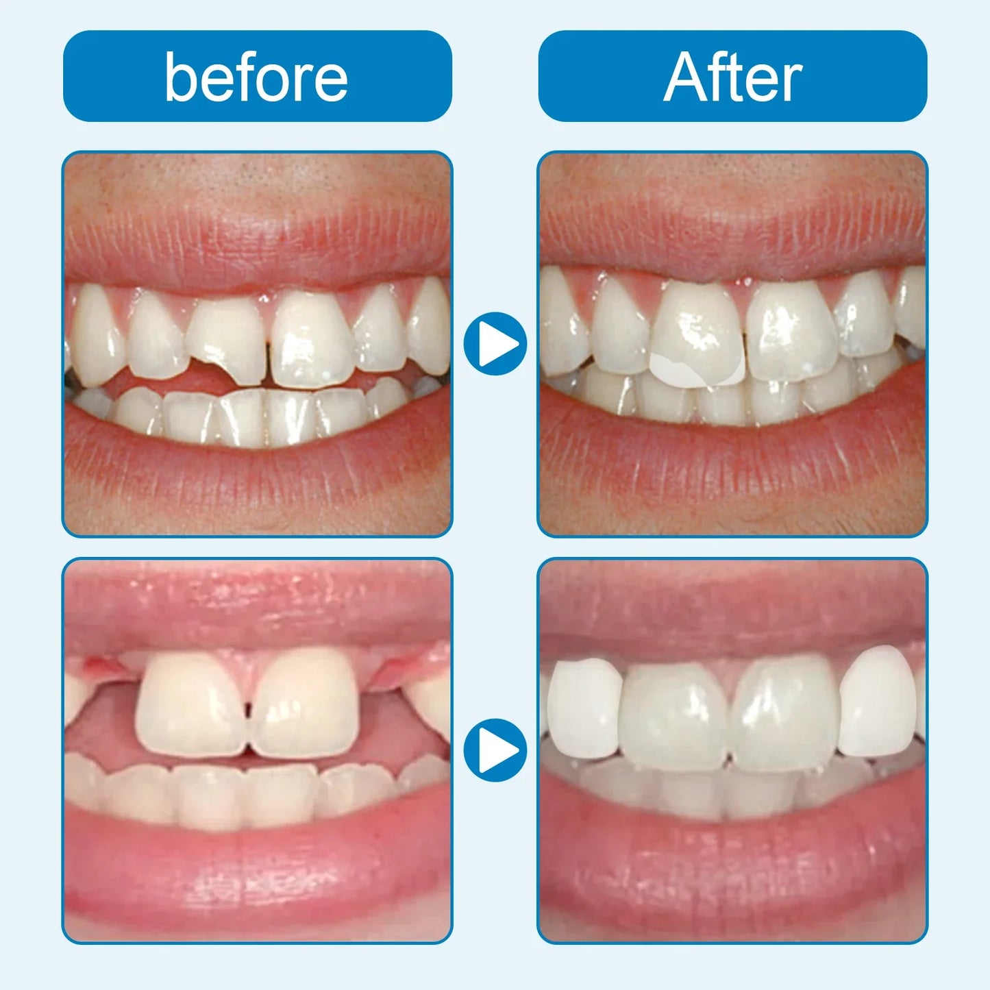 Moldable Tooth Gel Kit – Vampire Teeth & Gap Filler for Cosplay