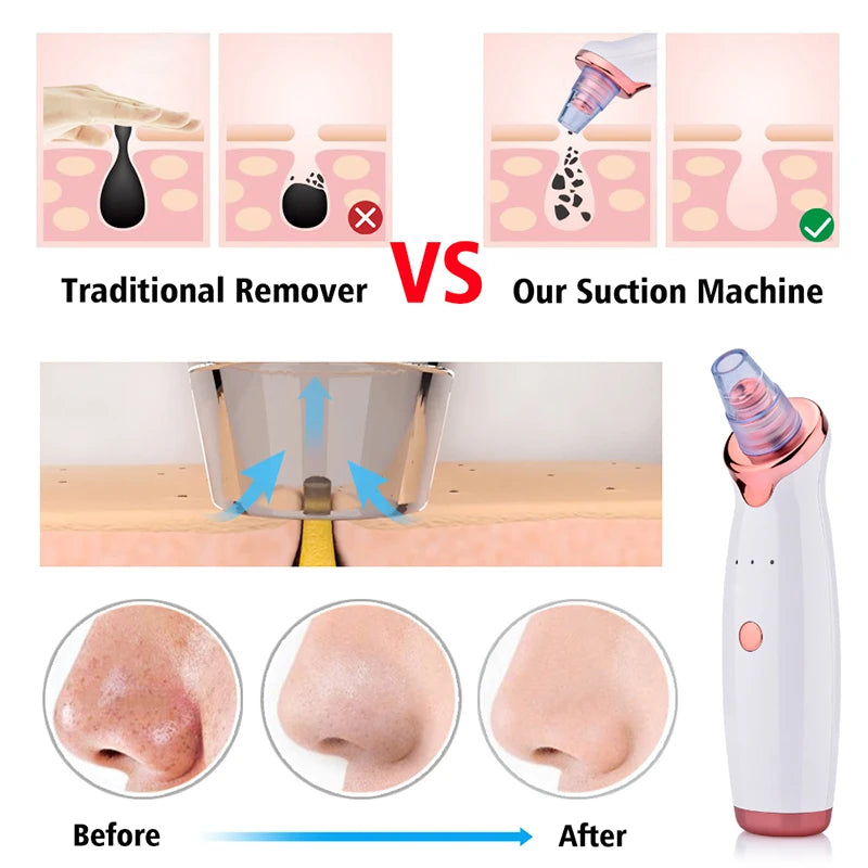 Blackhead Remover Diamond Dermabrasion Nose Vacuum Pore Cleanser Acne Pimple Suction Extractor USB Rechargeable Skin Care Tool Peaceful Pleasures Health and Wellness