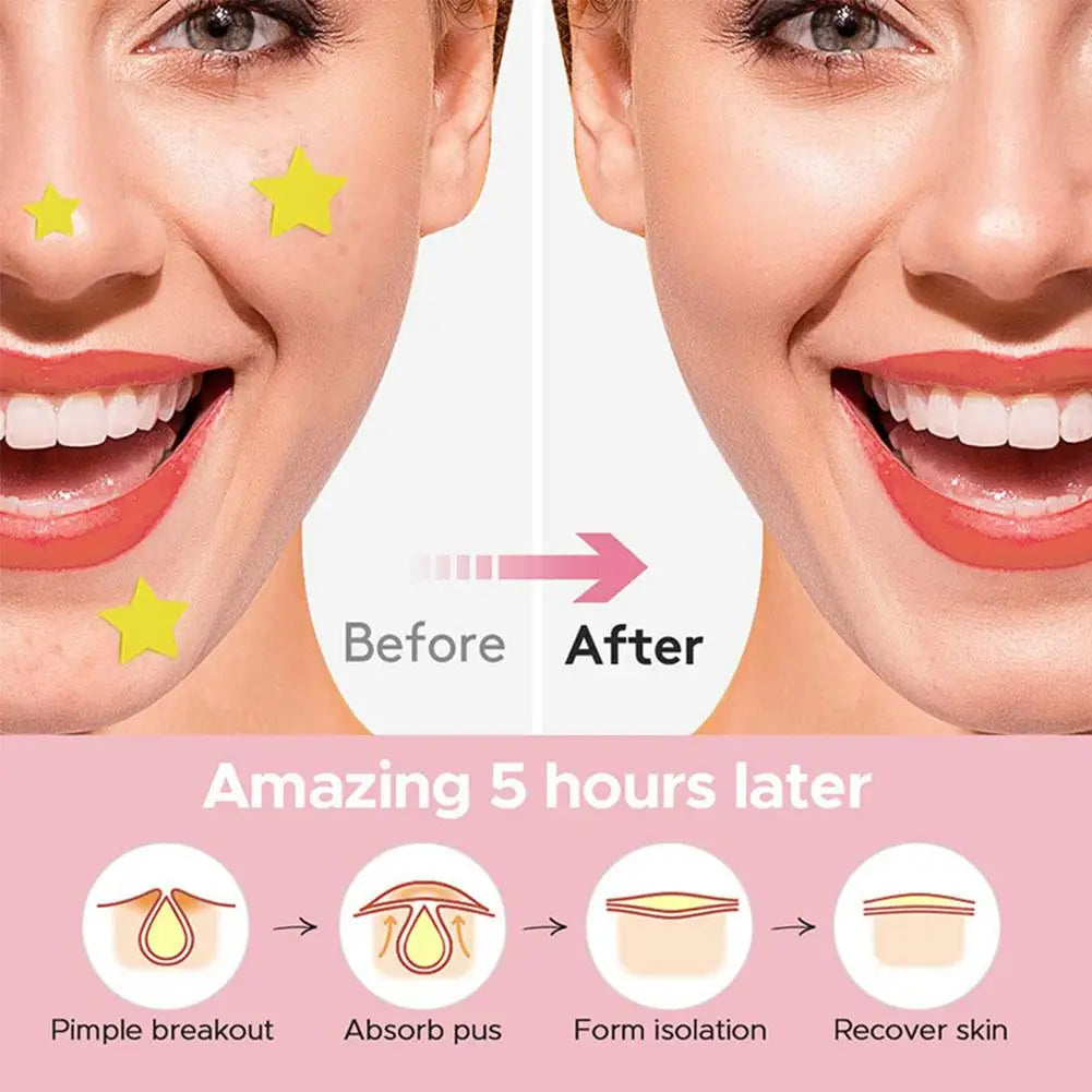 Jaysuing 600-Count Colorful Star Hydrocolloid Acne Patches – Large 12x9cm Sheet, Cute Star-Shaped Invisible Zit Cover Stickers Peaceful Pleasures Health and Wellness