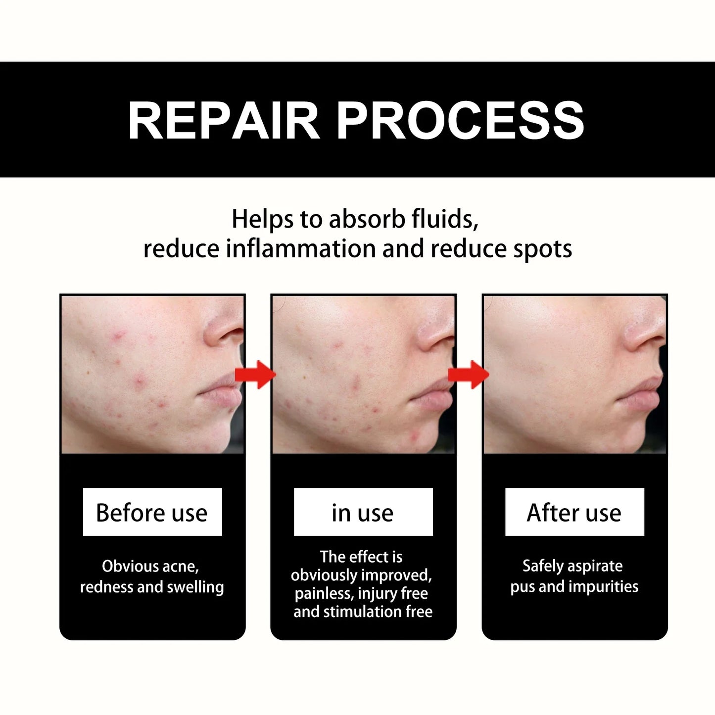 Hoygi Black Acne Patches – Spots, Blackheads & Skin Tone
