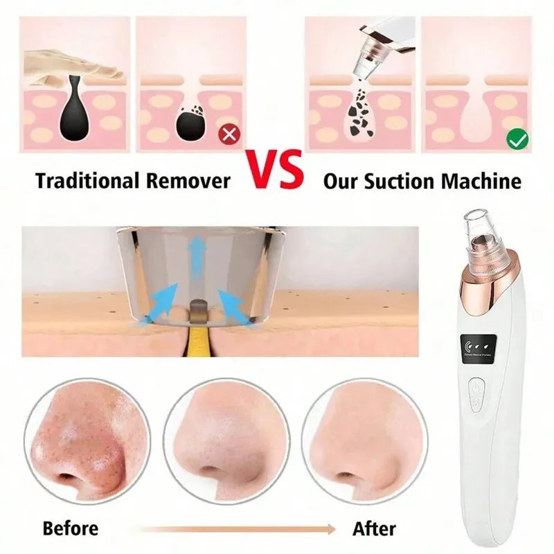 Electric Blackhead Remover Vacuum | 5-Level Pore Cleanser