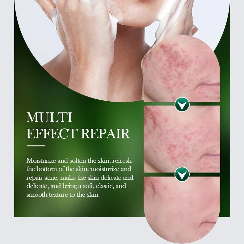 SADOER Tea Tree Mousse Facial Cleanser 150g | Oil Control