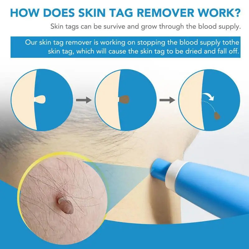 2-in-1 Skin Tag Removal Kit – Pen, Bands & Wipes | 2–8mm