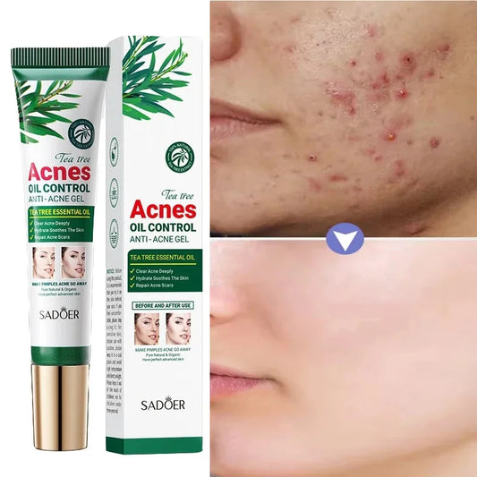 Tea Tree Acne Removing Cream Facial Mild Moisturizing Oil Control Acne Removing Facial Gel Eliminate Acne Pimples Beauty Health Peaceful Pleasures Health and Wellness Default Title