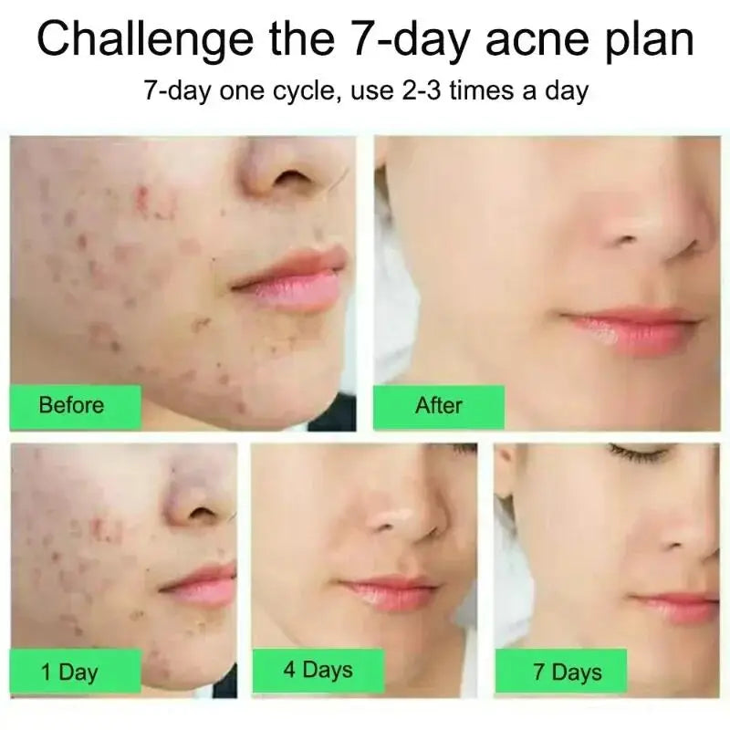 Salicylic Acid Acne Removal Cream Anti-Acne Repair Redness Pimple Spots Deep Cleaning Pore Oil Control Moisturizing Skin Care Peaceful Pleasures Health and Wellness