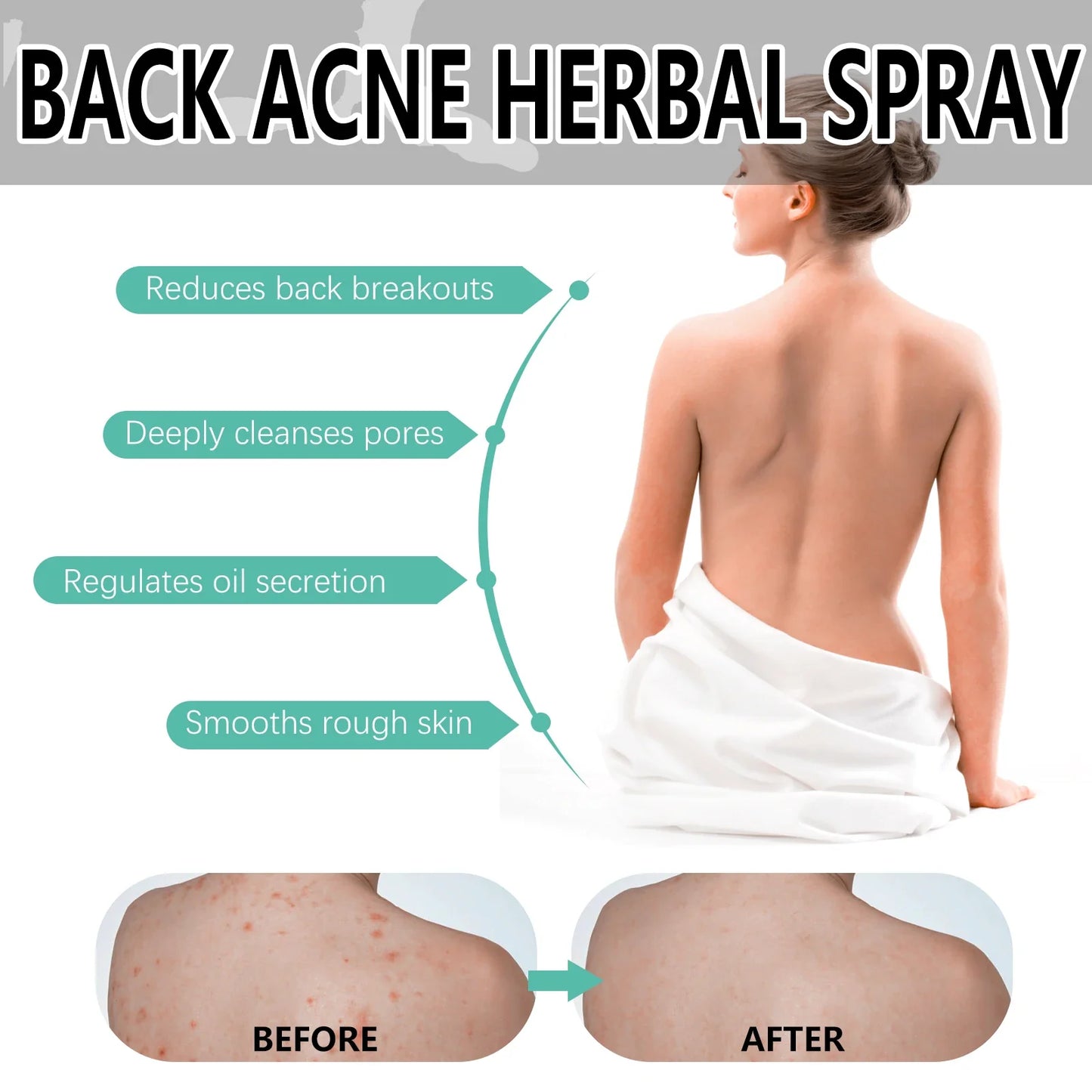 OceAura Herbal Acne Spray – Back, Shoulder & Pore Treatment