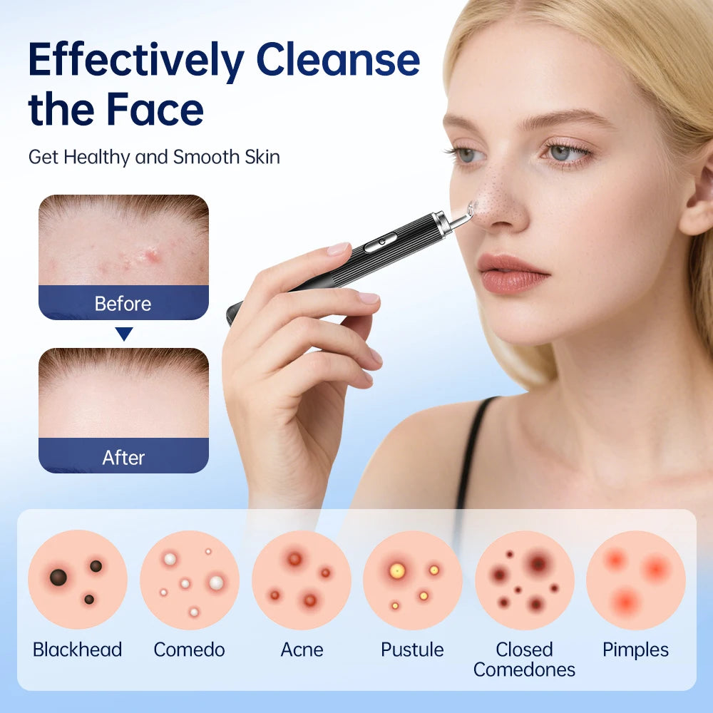 Visual Blackhead Remover with Camera Pimple Popper Extractor Tool Pore Cleaner Kit for Acne Comedone Whitehead Black Dots Remove Peaceful Pleasures Health and Wellness