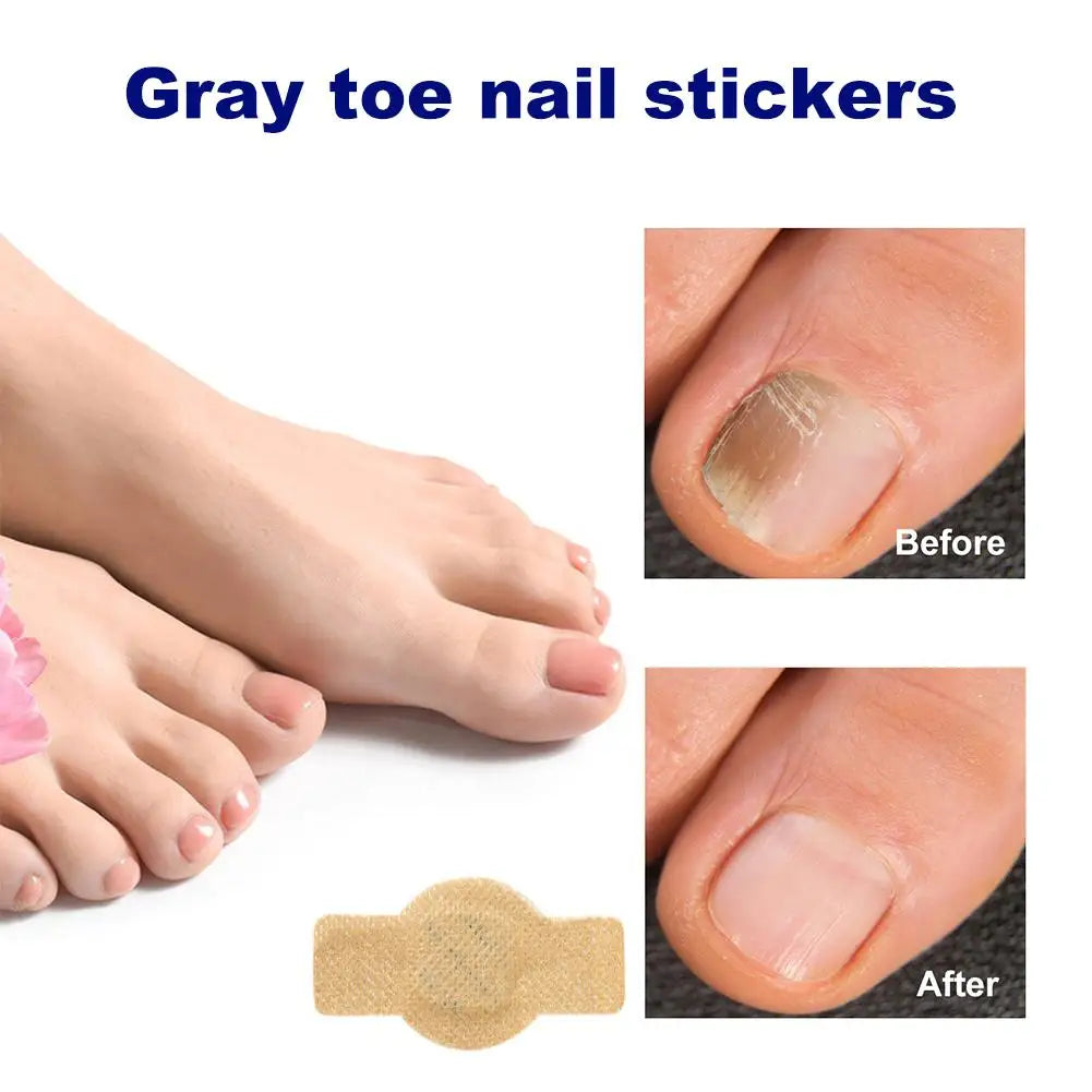 21pc Gray Toe Nail Sticker Fungal Nail Repair Patch Ingrown Correction Sticker Toenail Care Paronychia Nail Treatment Patch CarE Peaceful Pleasures Health and Wellness