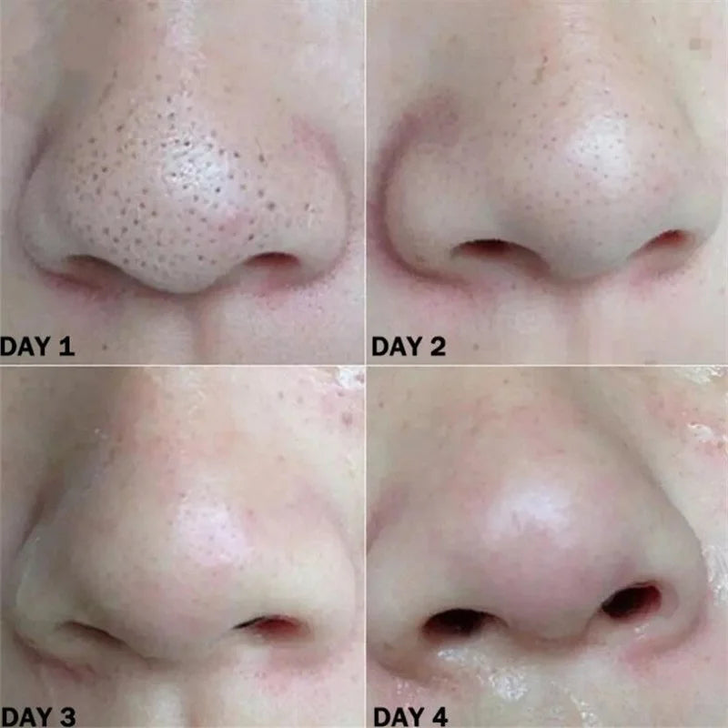 Nose Blackhead Remover Pore Strips – Deep Cleansing Mask