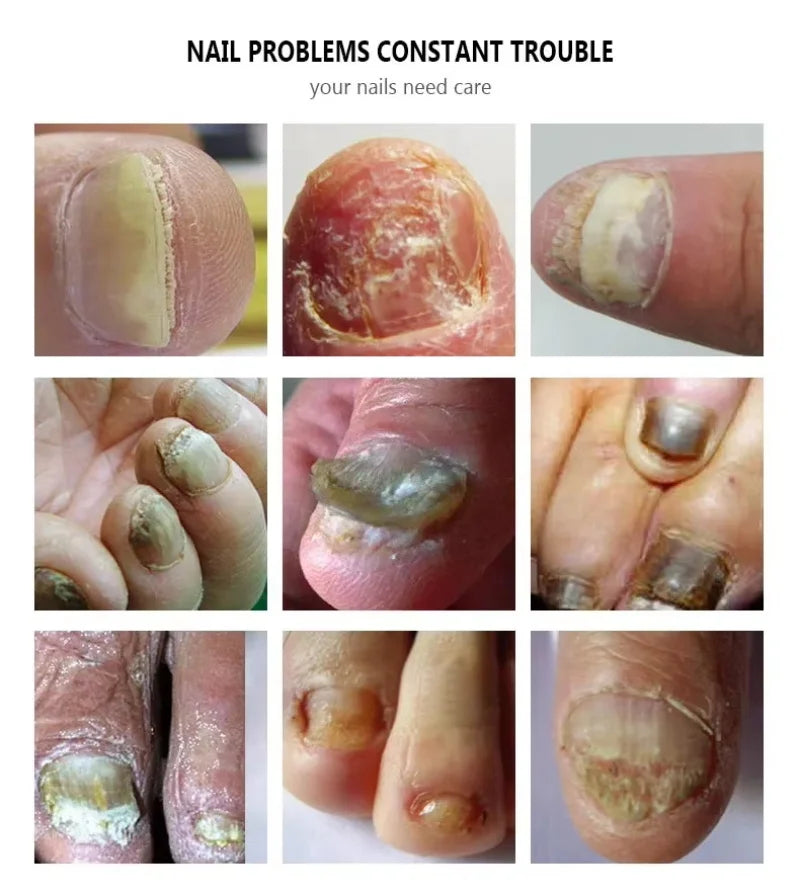 Nail Repair Serum – Foot & Toe Nail Restoration Oil