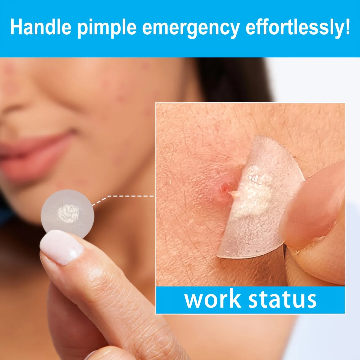 Hydrocolloid Acne Patches – Invisible, Waterproof | All Skin Types
