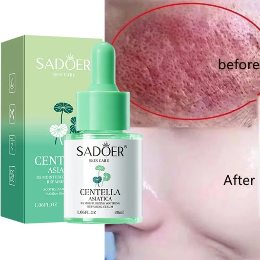 Facial Redness Repair Serum | Rosacea & Sensitive Skin Relief Face Redness Serum Peaceful Pleasures Health and Wellness