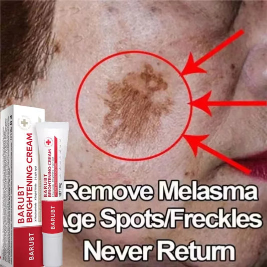 Effective Whitening Freckles Face Cream Removal Melasma Dark Spots Fade Melanin Pigmentation Corrector Brighten Repair Skin Care Peaceful Pleasures Health and Wellness