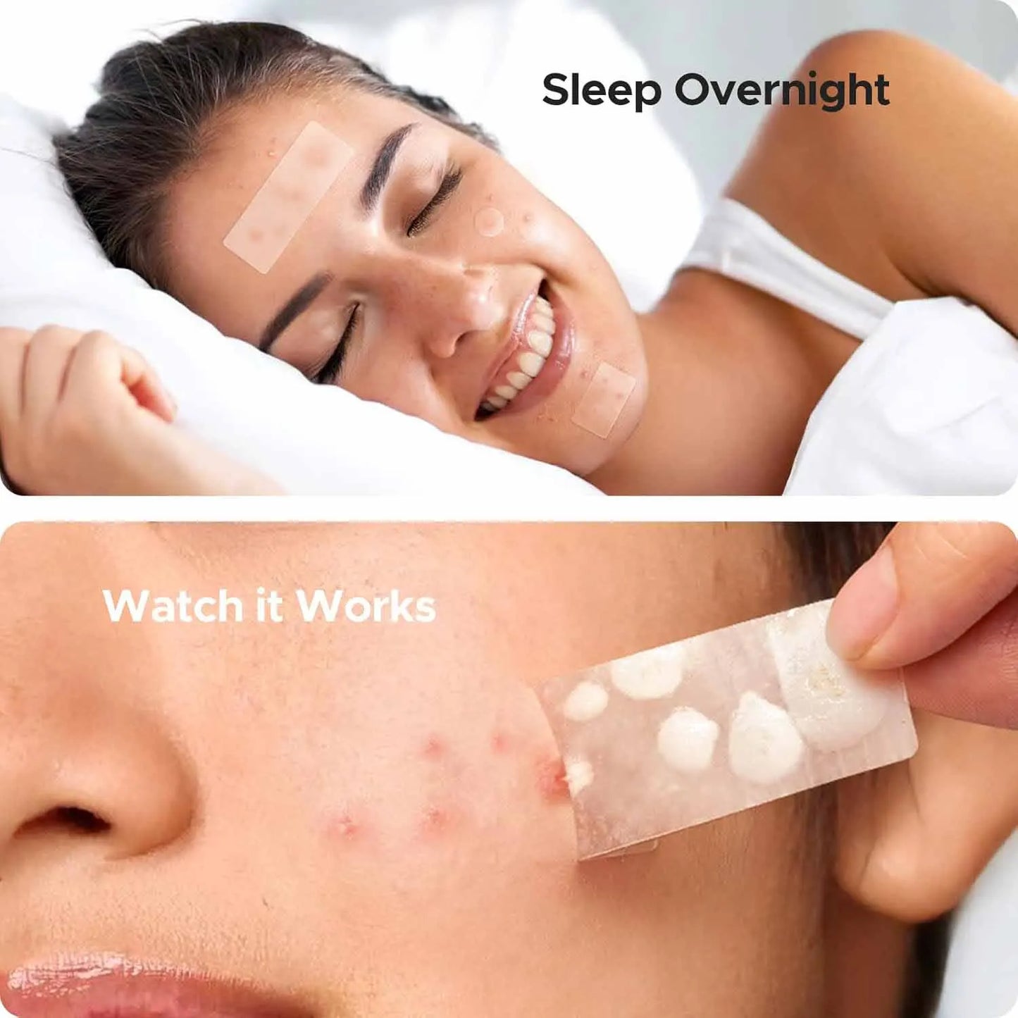 Hydrocolloid Acne Patches – Invisible & Waterproof | All Skin Types