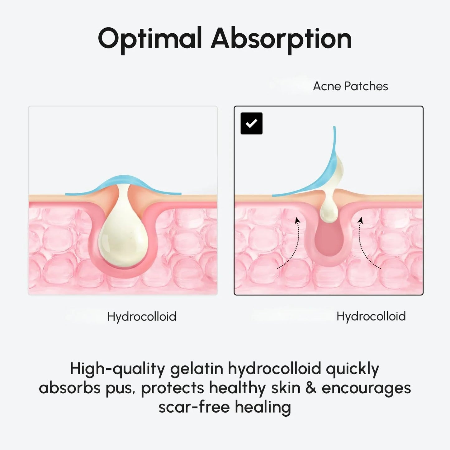 Hydrocolloid Acne Patches – Invisible & Waterproof | All Skin Types