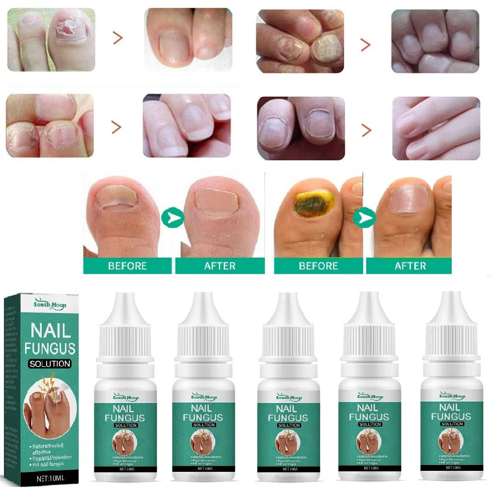 5-Pack Nail Repair Serum | Nail Restoration Essence 10ml