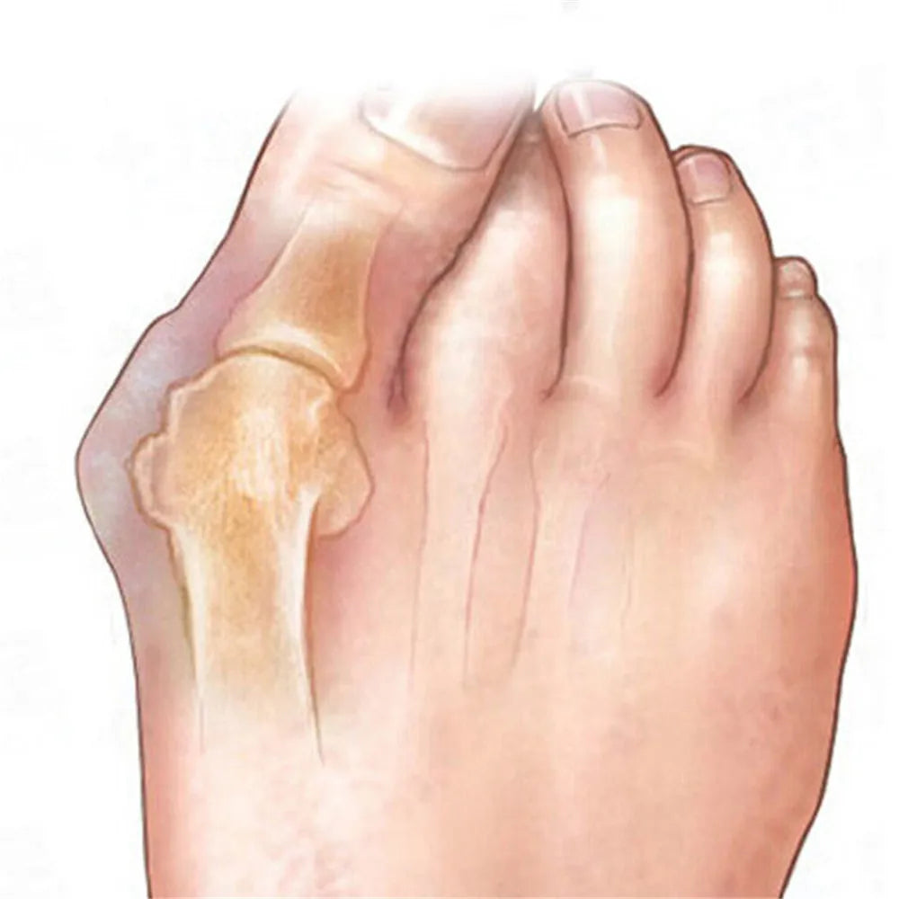 Toe Gel Separators & Bunion Corrector 2-Pack | Pain Relief