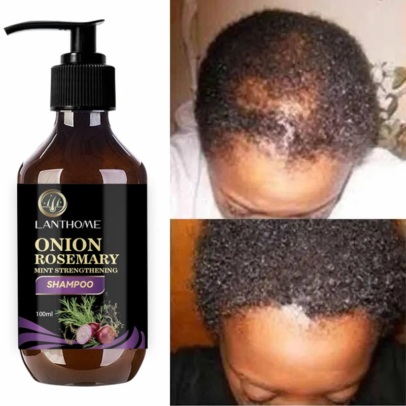 Hair Shampoo For Fast Hair Growth Rosemary Onion Hair Regrowth Shampoo Anti Hair Loss Effective Within 7 Day Hair Care Spray Peaceful Pleasures Health and Wellness