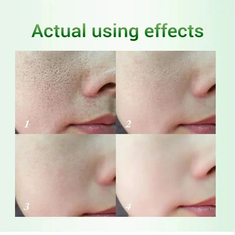 Salicylic Acid Pore Refining Cream – Oil Control & Blackhead