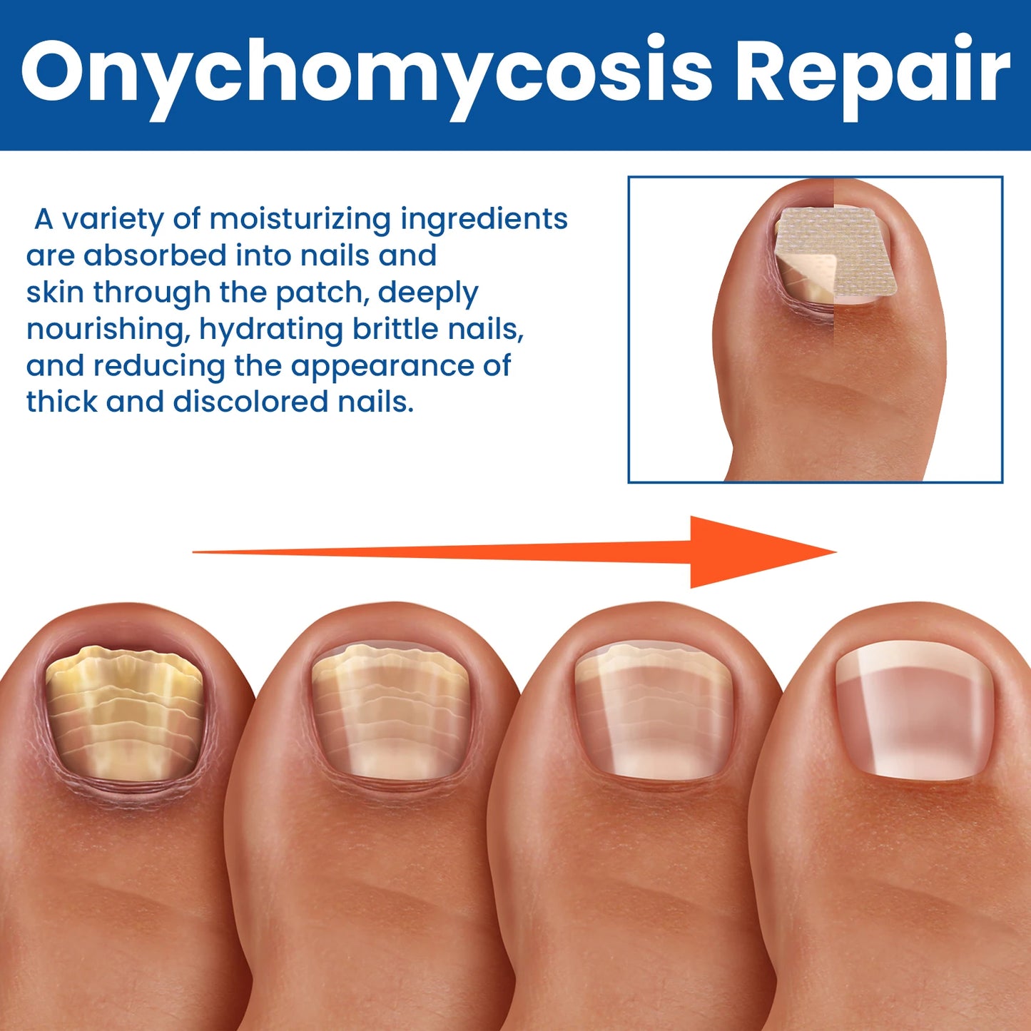 Nail Repair Patches – Ingrown Toenail, Fungus & Brittle Nail