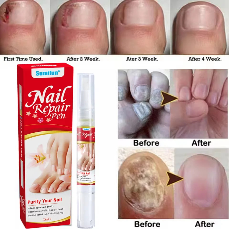 Fungal Nail Treatment Serum Foot Nail Fungus Removal Repair Gel Anti Infection Paronychia Onychomycosis Foot Nails Care Essence Peaceful Pleasures Health and Wellness